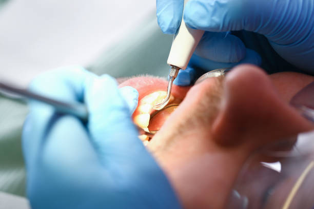 Best Emergency Dentist for Lost Fillings or Crowns in Oakley, CA